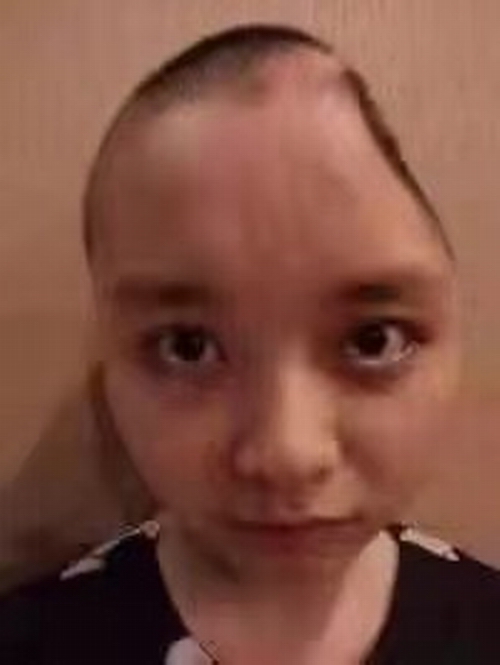 周娅手术后脑壳少一半。.jpg 周娅手术后脑壳少一半。.jpg