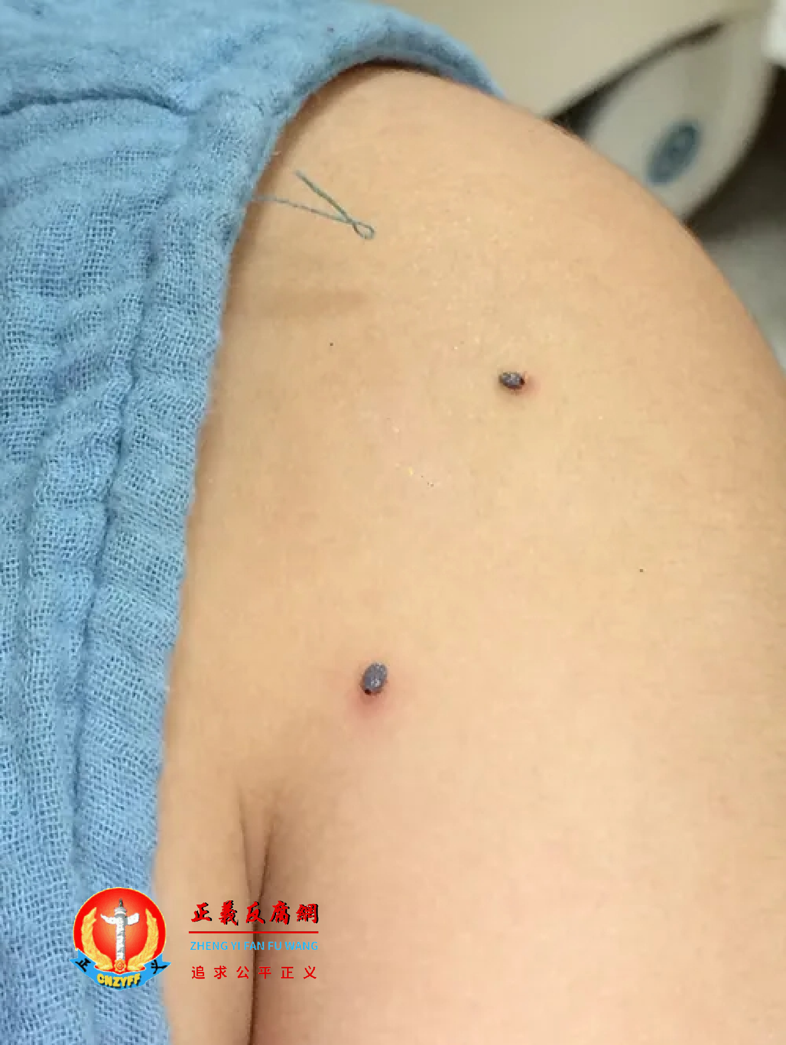 孩子皮肤上的蜱虫.png 孩子皮肤上的蜱虫.png